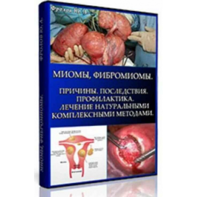 Миомы, Фибромиомы. Причины, мини инфопродукт №7 Юрий Фролов