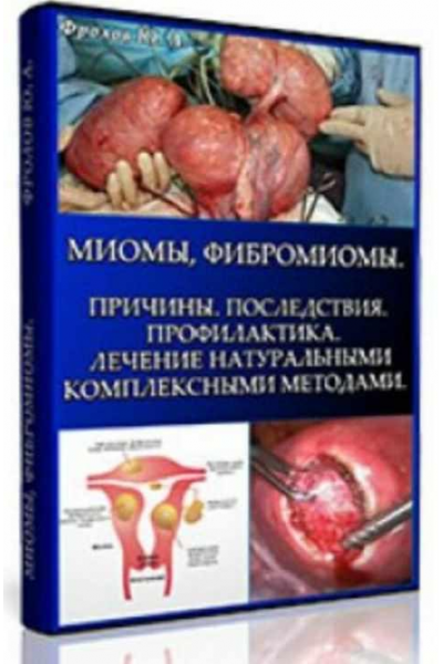 Миомы, Фибромиомы. Причины, мини инфопродукт №7 Юрий Фролов