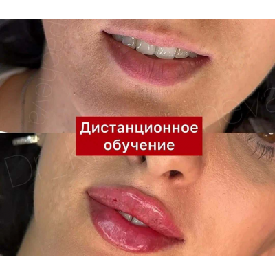Контурная пластика губ длинной иглой. Расита Хапачева