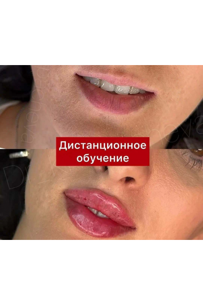 Контурная пластика губ длинной иглой. Расита Хапачева